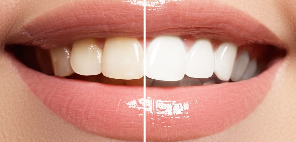 hammaste valgendus tulemus enne ja pärast